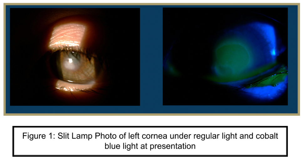 Slit Lamp Photo of left cornea under regular light and cobalt blue light at presentation