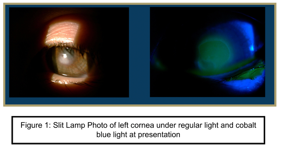 Slit Lamp Photo of left cornea under regular light and cobalt blue light at presentation Slit Lamp Photo of left cornea under regular light and cobalt blue light at presentation