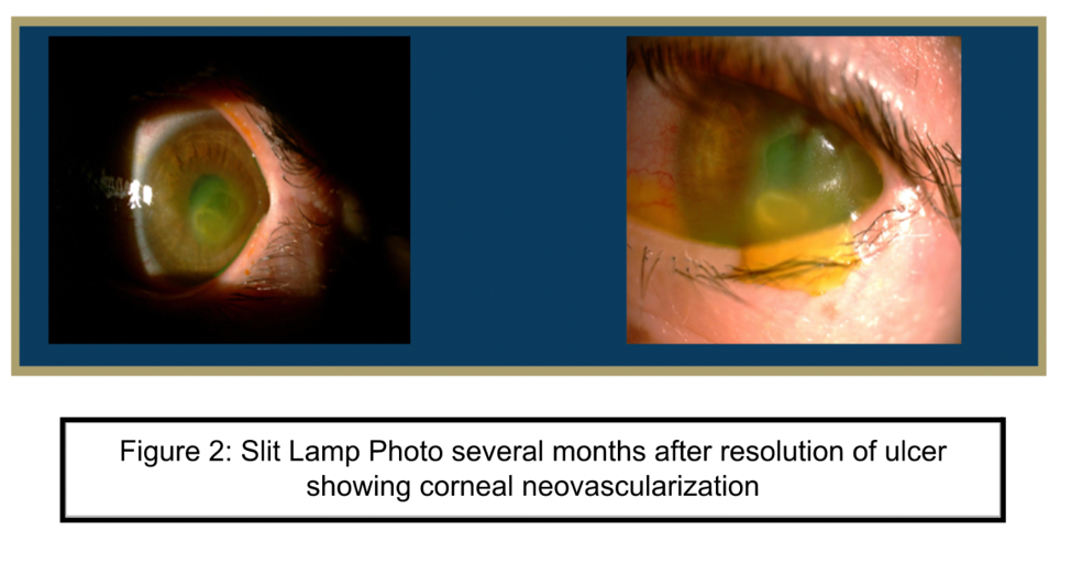 Slit Lamp Photo several months after resolution of ulcer showing corneal neovascularization Slit Lamp Photo several months after resolution of ulcer showing corneal neovascularization