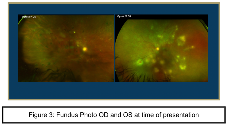 Fundus Photo OD and OS at time of presentation Fundus Photo OD and OS at time of presentation