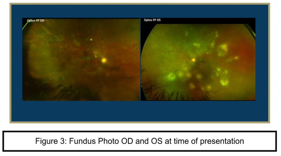 Fundus Photo OD and OS at time of presentation