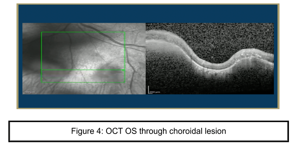 OCT OS through choroidal lesion
