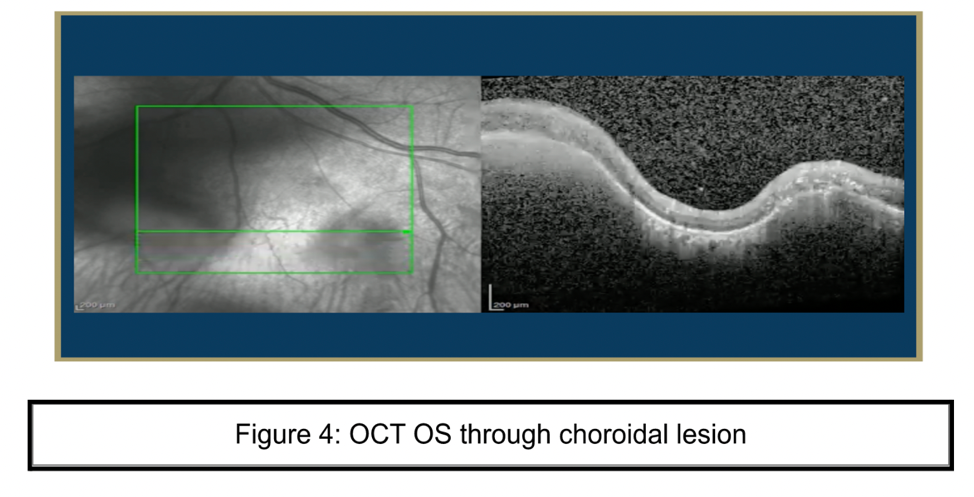 Figure 4: OCT OS through choroidal lesion OCT OS through choroidal lesion