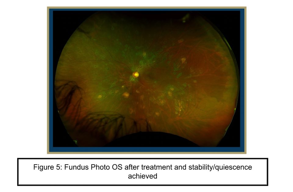 Fundus Photo OS after treatment and stability/quiescence achieved Fundus Photo OS after treatment and stability/quiescence achieved