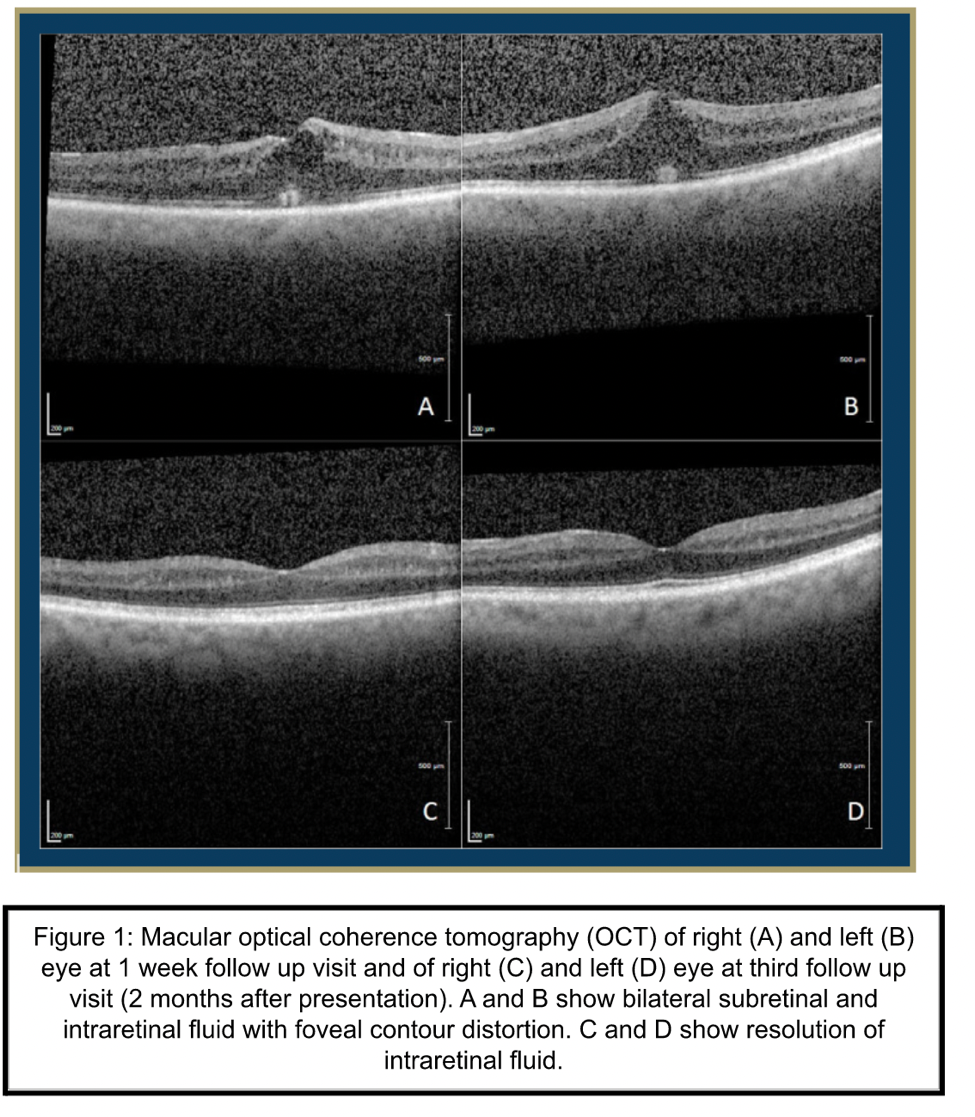 Bilateral cystoid macular edema before and after discontinuation of siponimod
