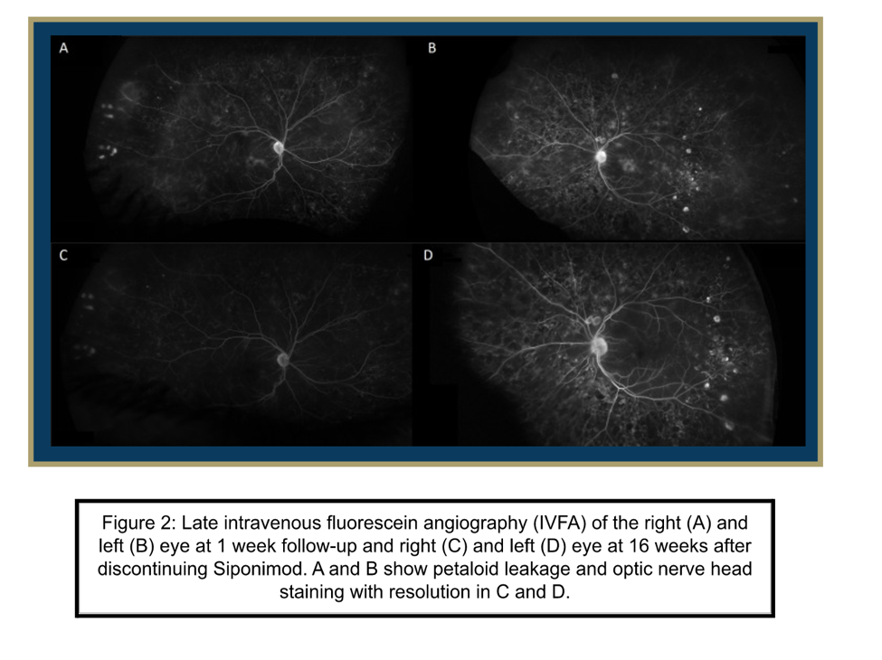 Fluorescein Angiogram of siponimod macular edema