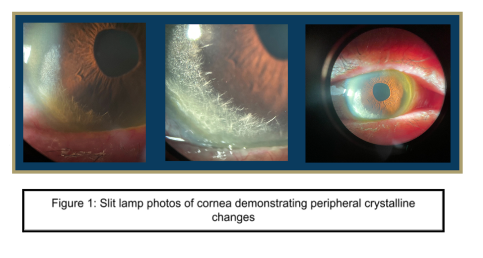 Crystalline keratopathy