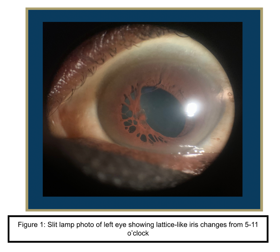 Persistent pupillary membranes in a left eye