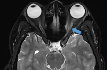 T2 Weighted MRI showing increased signal about the left optic nerve