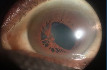 Persistent pupillary membranes in a left eye
